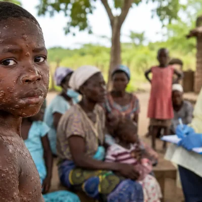 Un traitement contre le mpox existe, mais il reste inaccessible : pourquoi ?