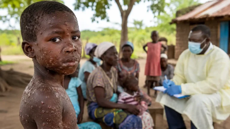 Un traitement contre le mpox existe, mais il reste inaccessible : pourquoi ?