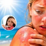 Coups de soleil : quand une brûlure devient une urgence médicale